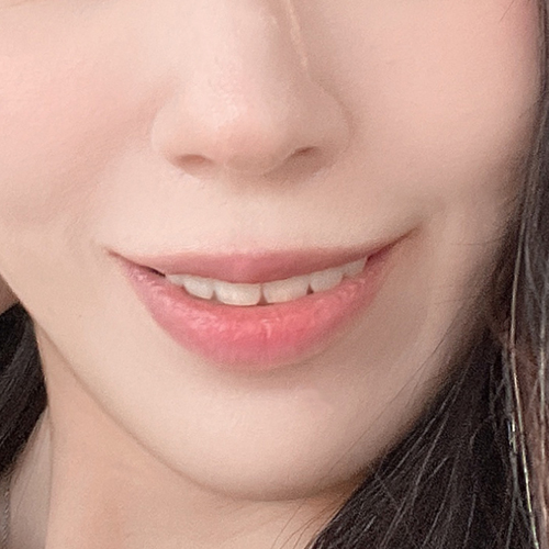 시술 전